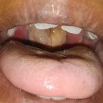Heightened Surveillance Against Diphtheria in Benue as Cases Rise Nationwide