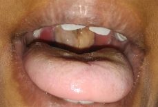 Heightened Surveillance Against Diphtheria in Benue as Cases Rise Nationwide