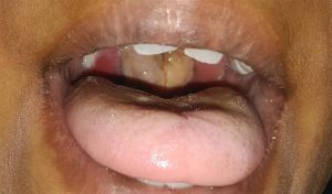 Heightened Surveillance Against Diphtheria in Benue as Cases&hellip;