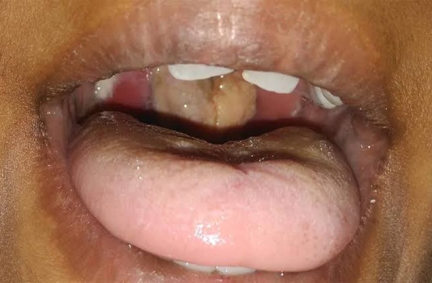 Heightened Surveillance Against Diphtheria in Benue as Cases Rise Nationwide